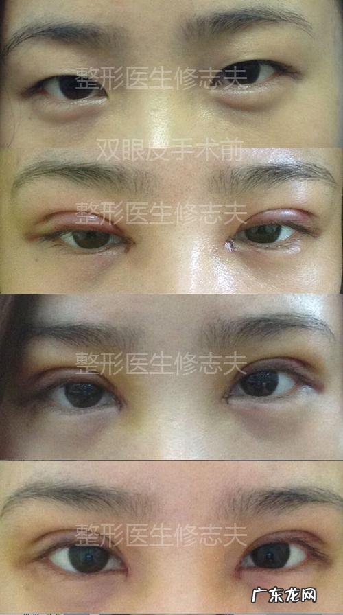 开扇形双眼皮修复案例照片 全切开扇形双眼皮案例照片