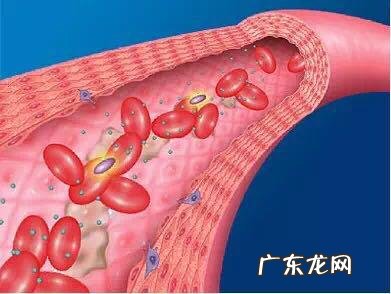 日常如何养护血管,预防脑梗?