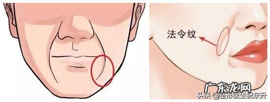玻尿酸填充法令纹几天有效果？