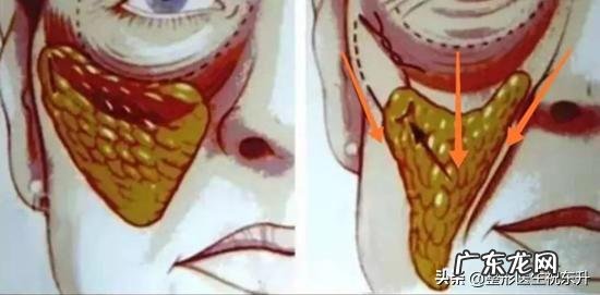 玻尿酸填充法令纹几天有效果？