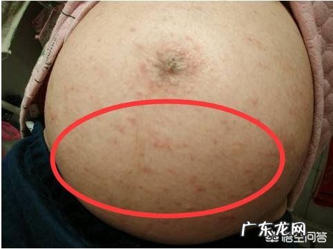 怀双胞胎34周肚皮痒得难受,可以用茶叶水洗肚子吗?