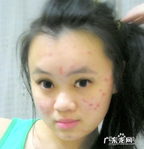 继发性肥胖有哪些原因导致的