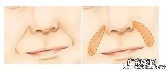 法令纹填充后效果明显吗?