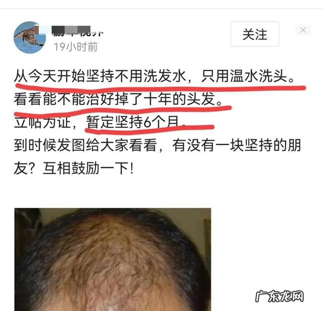 治疗秃头的洗发水 秃头头发稀少用什么洗发水