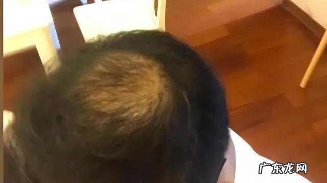秃顶十五年居然长出头发 秃顶男子不用洗发水后长出头发
