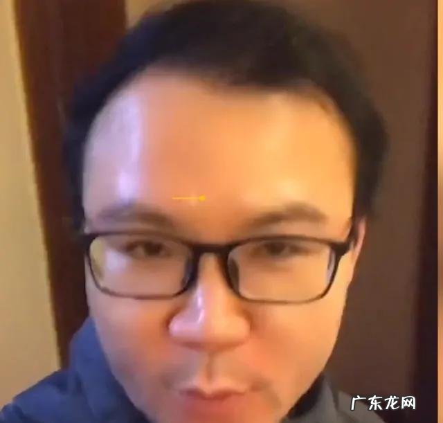 秃顶十五年居然长出头发 秃顶男子不用洗发水后长出头发