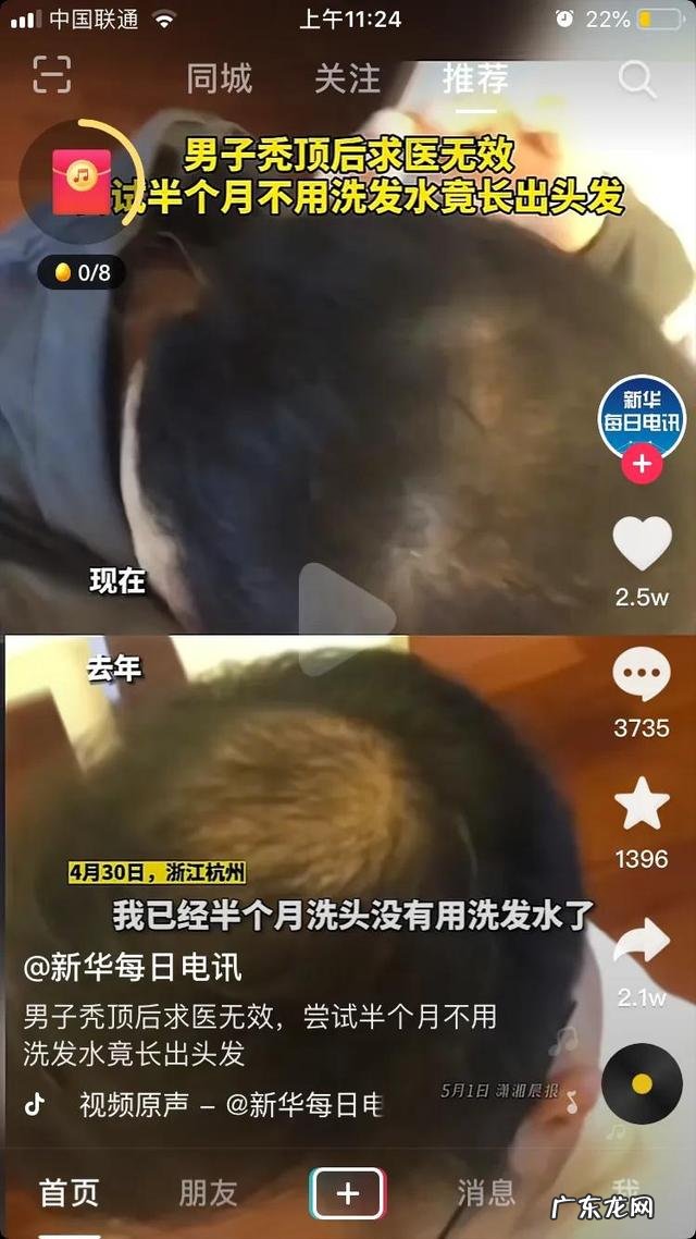 秃头小妙招 解决秃头的小妙招