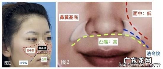 玻尿酸去法令纹可以维持多长时间？