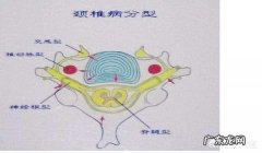 交感型颈椎病最好的zhi疗方法是什么？ 专zhi交感型颈椎病的特效疗法