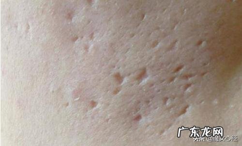 痘印怎么去掉最快最有效,有哪些方法