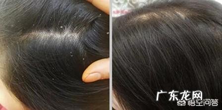 头皮上抠出的白泥是什么?如何去掉这些东西?