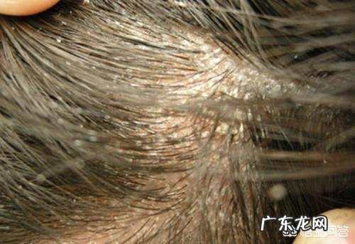 头皮上抠出的白泥是什么?如何去掉这些东西?