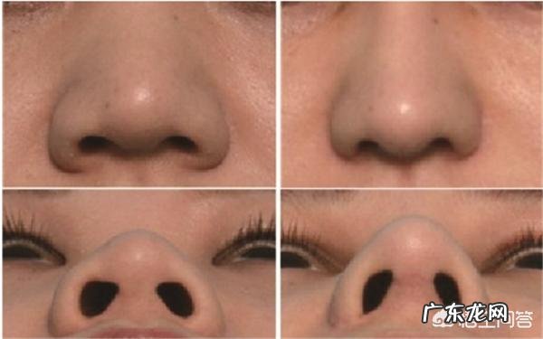 鼻头鼻翼缩小的方法有哪些？