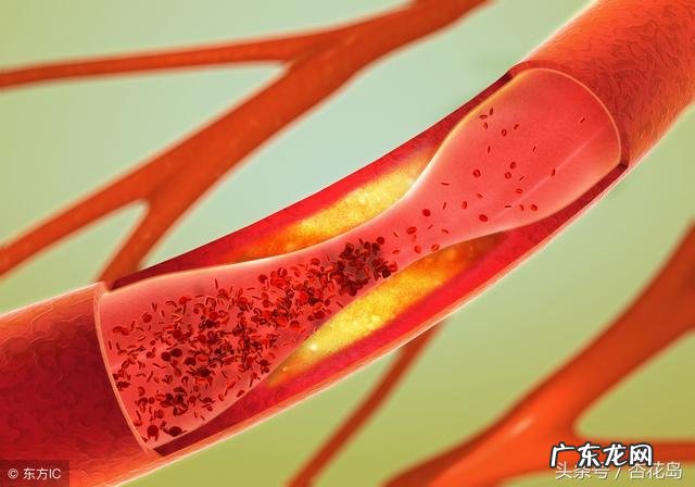 为什么有些人会患上脑梗?得了脑梗怎么办?