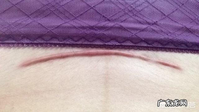 已经剖腹产两次，还能再要孩子吗