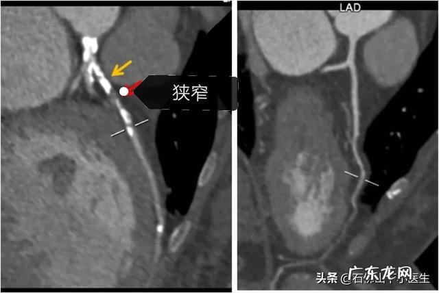 血糖正常值是多少？糖尿病如何降血糖？
