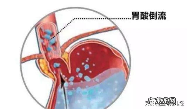 孕妇胃酸反流一般发生在怀孕的什么时候?