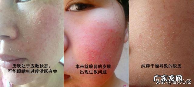 皮肤不知不觉变粗糙是因为螨虫吗