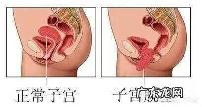 产后坐月子如何预防子宫下垂？