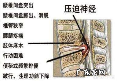 腰间盘突出除手术外，还有哪些好的方法来缓解？