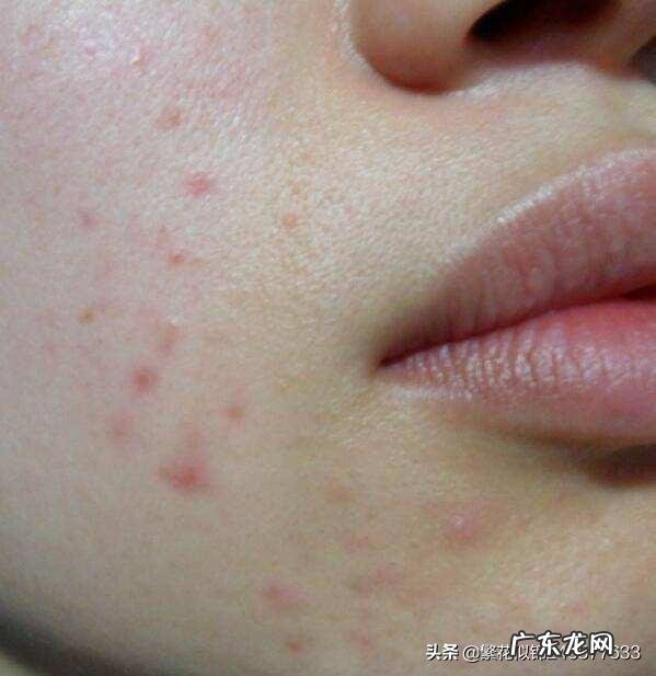 螨虫脸是怎么回事有什么特征吗