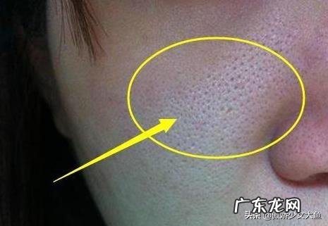 螨虫脸是怎么回事有什么特征吗