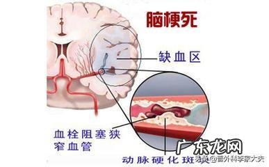 怎么现在这么多年轻人也会患脑梗?