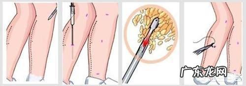 吸脂瘦小腿术后塑身衣要穿多久?
