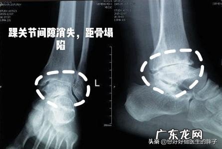 扭伤脚怎么消肿最快最有效？