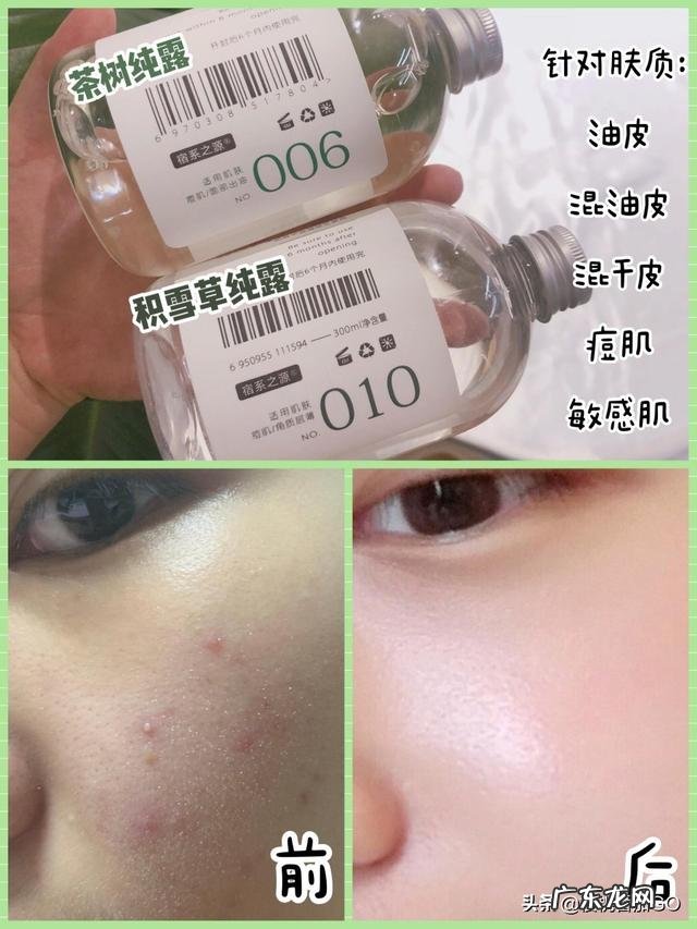 哪款纯露可以祛痘,淡化痘印,最好用?