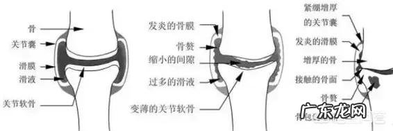 运动时听见关节响是怎么回事?