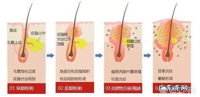 脸上的痘痘、痘印反复出现,如何彻底去掉?
