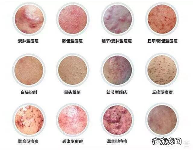 脸上的痘痘、痘印反复出现,如何彻底去掉?