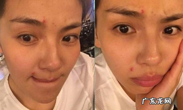 痘印大作战,如何战胜痘痘