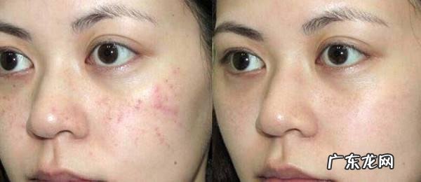 痘印大作战,如何战胜痘痘