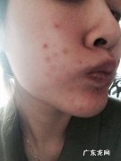 痘印大作战，如何战胜痘痘