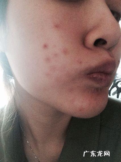 痘印大作战,如何战胜痘痘