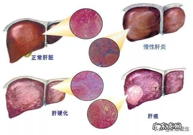 如果十几年前有乙肝，到现在都没吃药，会怎样？