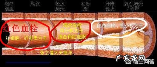 得了血栓,吃什么好得快?