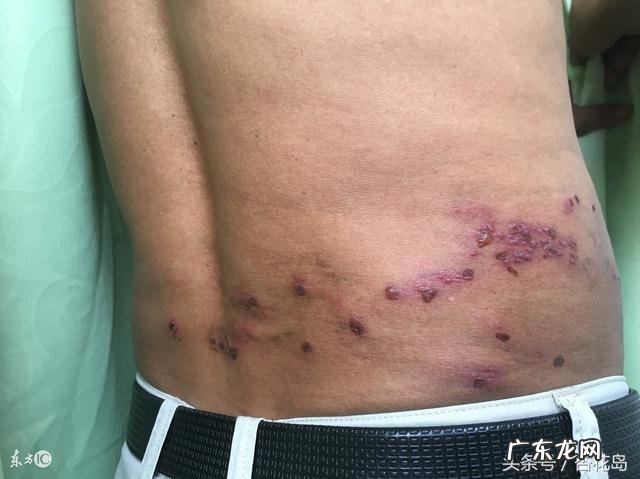 为什么感觉身边得带状疱疹的人越来越多？