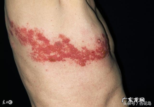 为什么感觉身边得带状疱疹的人越来越多？