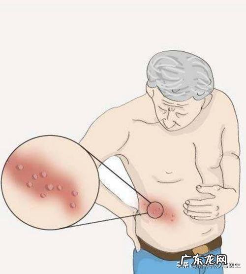 为什么感觉身边得带状疱疹的人越来越多？