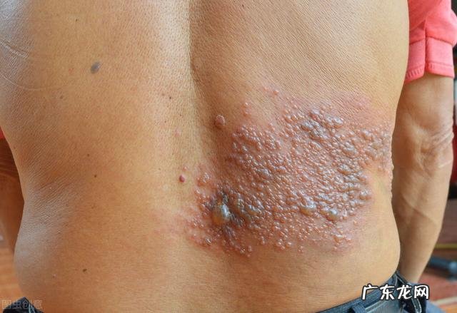 为什么感觉身边得带状疱疹的人越来越多？