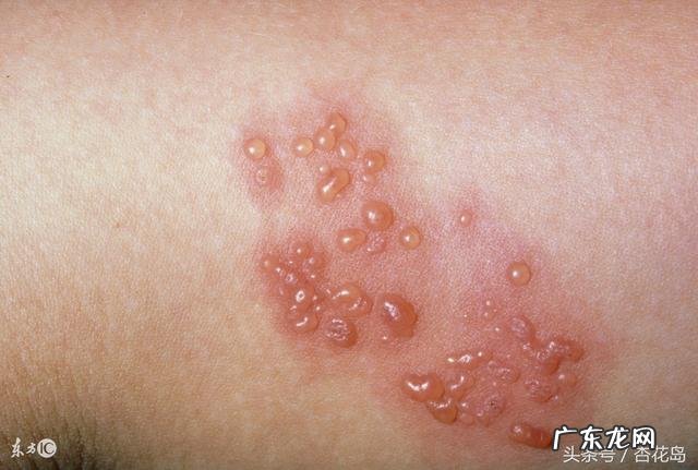 为什么感觉身边得带状疱疹的人越来越多？