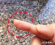 脸很油，毛孔里还有好多像小虫一样的东西，这是怎么了？ 脸油毛孔大用什么护肤品比较好