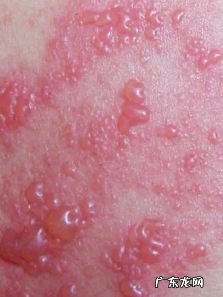 带状疱疹自愈多久能吃牛羊肉呢？