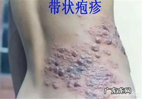 带状疱疹自愈多久能吃牛羊肉呢?