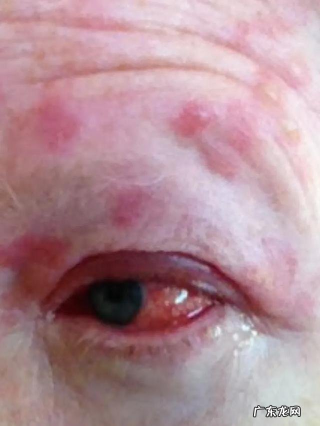 带状疱疹自愈多久能吃牛羊肉呢？