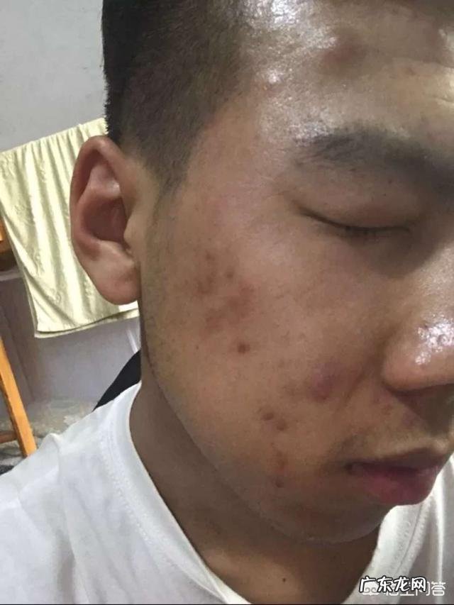 体内虚火旺盛，易长痘痘咋办？