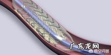 心脏装支架后波立维要吃多久